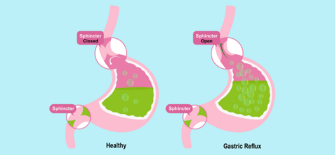 Ubat Gastrik di Farmasi – Jenis dan Kesesuaian Dengan Jenis Gastrik